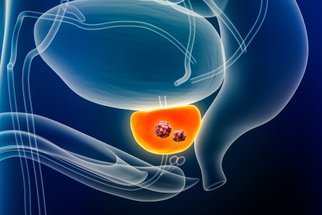 Rakovina prostaty je největším postrachem mužů. Jak se jí vyhnout a co obnáší prevence?