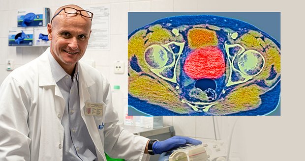 Klíčovou roli proto hraje včasné vyhledávání onemocnění prostřednictvím organizovaného screeningu, který v České republice funguje od roku 2024.