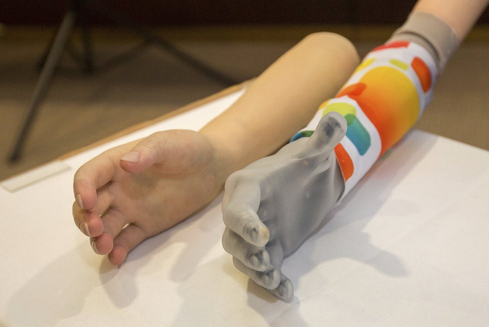 Moderní bionická ruka vyjde na 1,5 milionu a pojišťovna jí většinou neproplácí. 17leté Kamile se na ni složila veřejnost.
