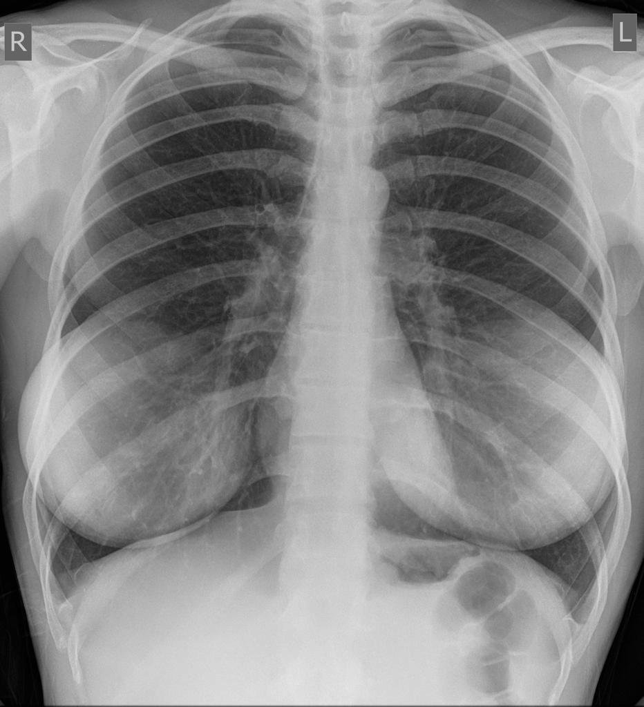 CIZÍ Pro srovnání: Takto vypadá snímek poprsí, ve kterém jsou silikonové implantáty.