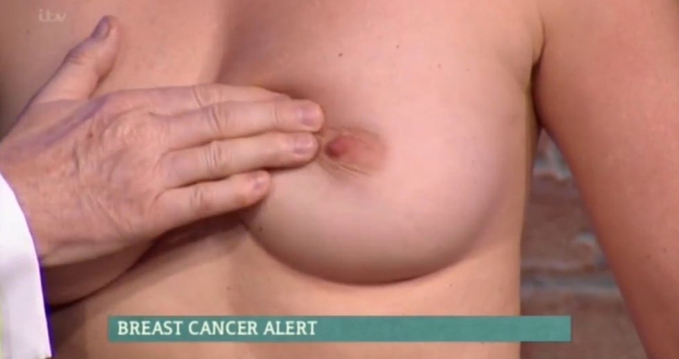 Lékař Christ Steele ukazoval postup při vyšetření rakoviny prsu.