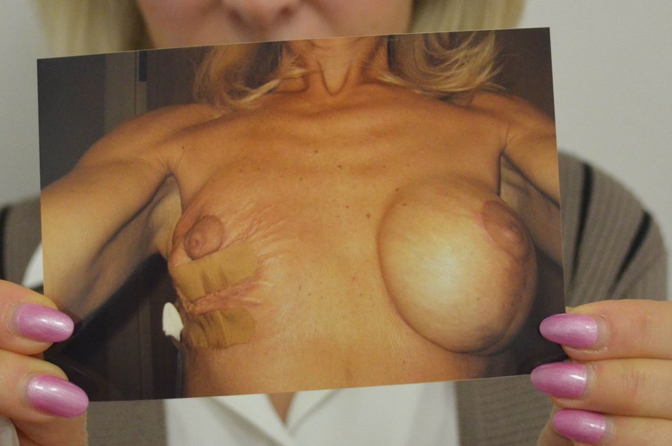 Z pravého prsa musel být nakonec vyjmut implantát a žena o něj prakticky přišla.