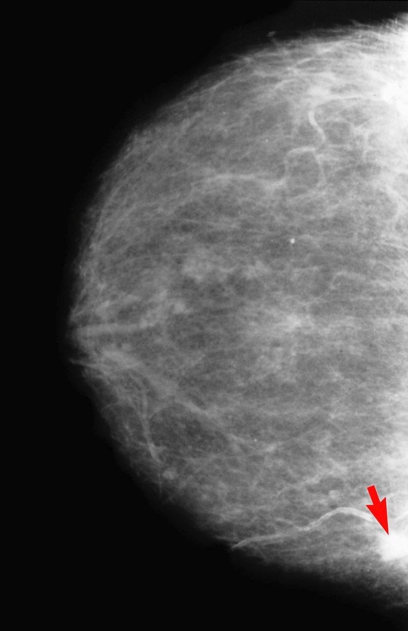 Rakovina prsu