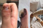 Dívka (20) si kousáním nehtů vypěstovala rakovinu! Lékaři jí museli amputovat celý prst.