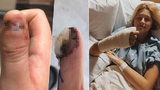 Dívka (20) si kousáním nehtů způsobila rakovinu! Lékaři jí museli amputovat kus ruky