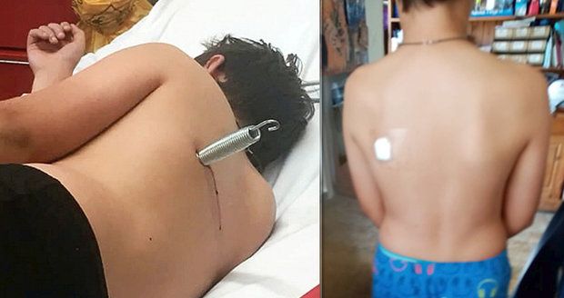 Trampolína poranila dítě (12): Uvolněná pružina mu prostřelila záda! 