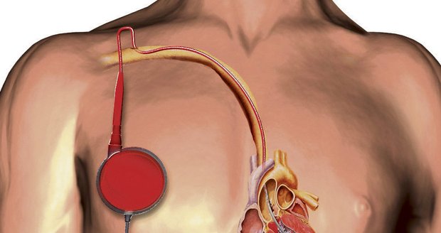 Pulzní pumpa přečerpává krev ze srdce do oběhu, a pomáhá tak nahrazovat práci levé komory srdce, která je infarktem poškozena.