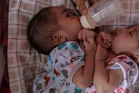 Holčičky se narodily jako siamská dvojčata: Rozdělení bude stát 2,5 milionu!