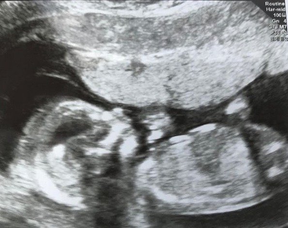 Rodina zveřejnila ultrazvuk na kterém je vidět malá dcerka.