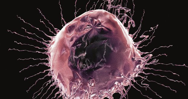Takto vypadá zvětšená rakovinná buňka prsu - ilustrační foto