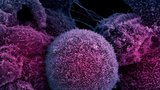 Rakovina v Česku bují, onemocní každý třetí z nás. Je třeba víc strojů i sester