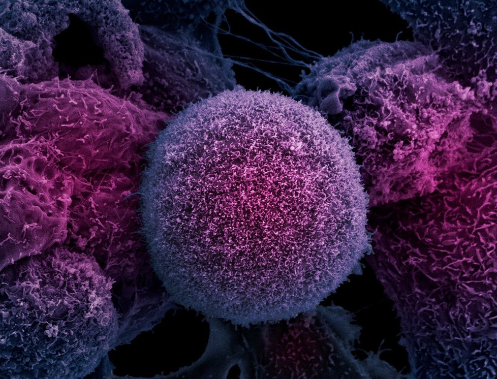 Buňka rakoviny.