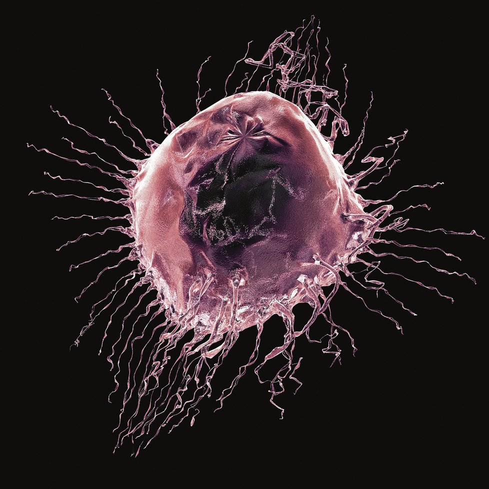 Zvětšená rakovinná buňka v prsu