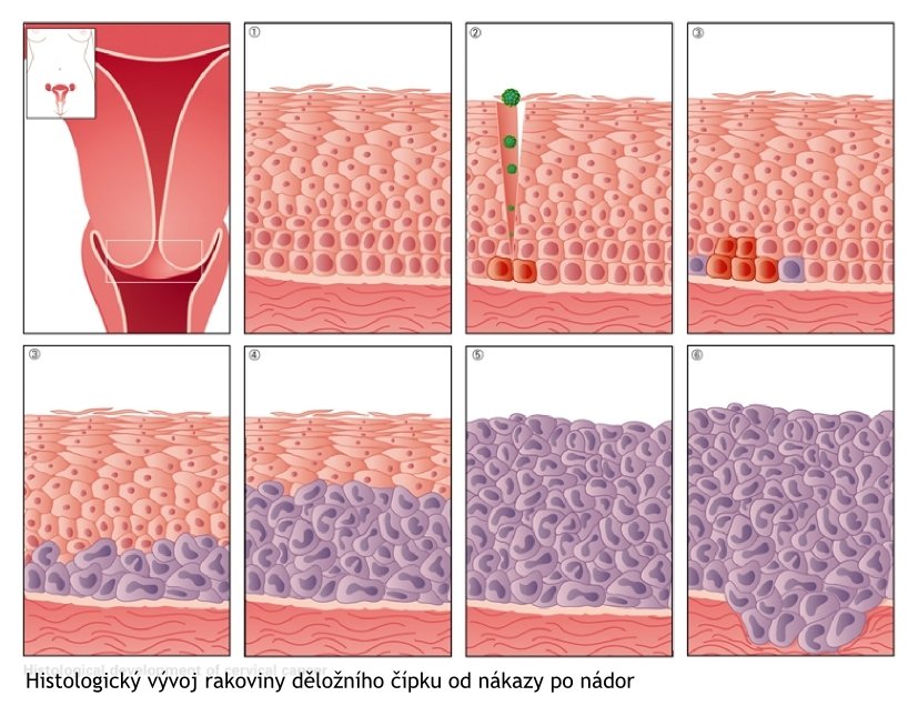Histologický vývoj rakoviny děložního čípku