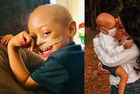 Malý hrdina svůj život vybojoval, rakovina mu ale vzala horní ret i vlasy!