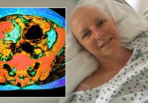 Ivana contracted insidious ovarian cancer
