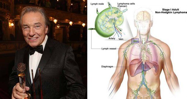 Karel Gott čelí nejtěžšímu boji - rakovině. Jak v těle roste nádor?