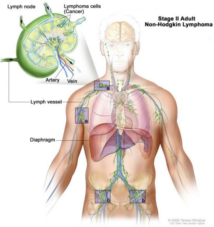 STADIUM II: Rakovina se objeví ve dvou nebo více mízních uzlinách, buď nad, nebo pod bránicí.