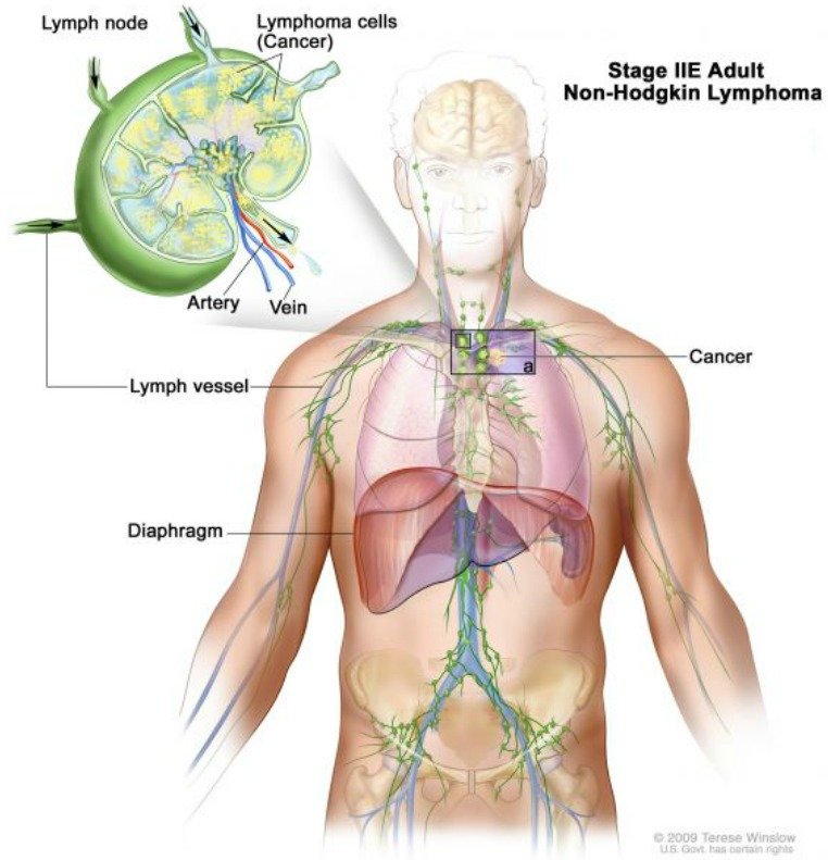 STADIUM IIE: Zásadní moment ve vývoji onemocnění! Rakovina po dvou nebo více mízních uzlinách (nad, nebo pod bránicí) napadá rovněž jinou oblast či orgán na téže straně bránice. V tomto případě jsou to plíce.