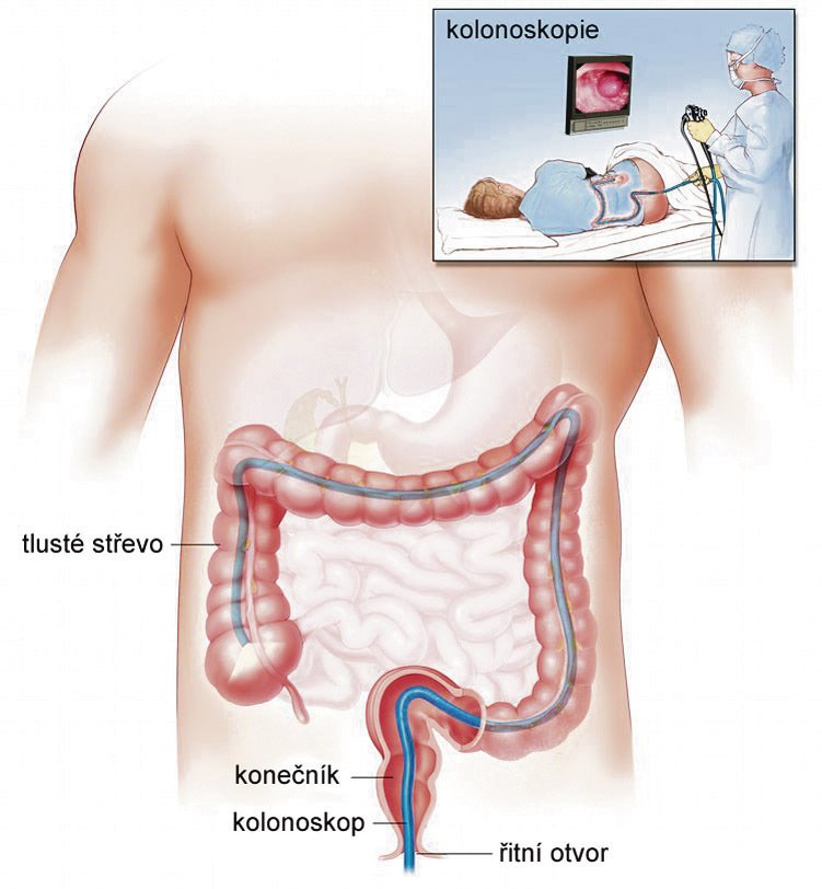 Modrá trubička znázorňuje kolonoskop, který dokáže střevo vyšetřit po celé jeho délce