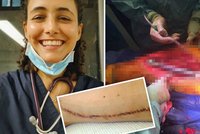 Studentce medicíny odhalili pražští lékaři nádor: Kvůli rakovině jí sebrali stehenní kost