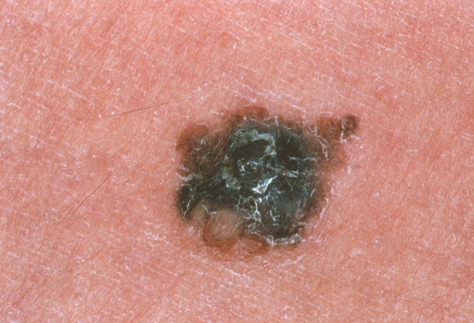 Příklad, jak může vypadat melanom kůže.