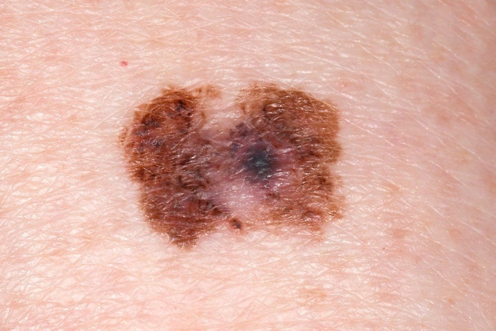 Příklad, jak může vypadat melanom kůže.