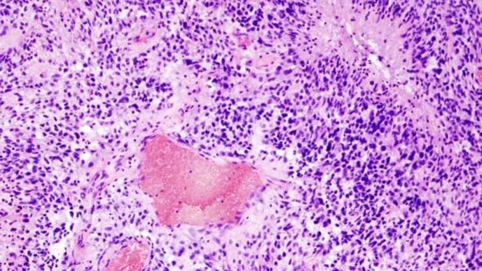 rakovina mozku: glioblastom - histopatologický vzorek