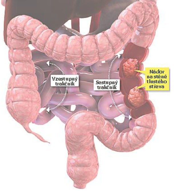 Češi drží smutné prvenství v počtu případů rakoviny tlustého střeva v Evropě.
