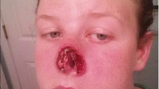 Myslela si, že má na nose pupínek, nakonec to byla rakovina! Myslela si, že má na nose pupínek, nakonec to byla rakovina!