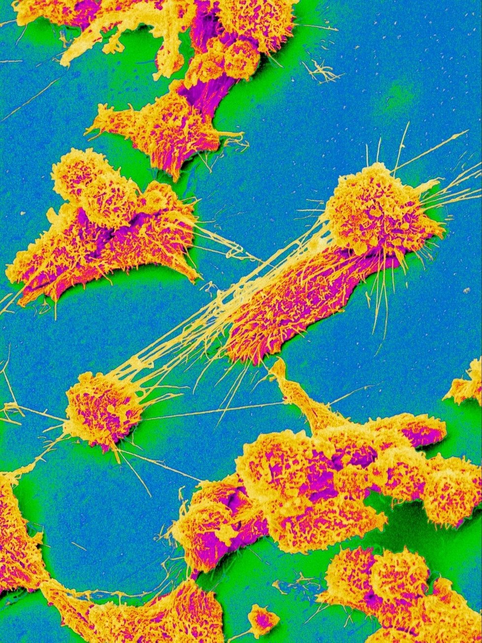 Rakovinové buňky pod mikroskopem