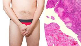HPV virus může způsobit rakovinu penisu.