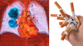 Rakovinu plic způsobuje hlavně kouření