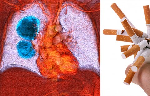 Do ordinací míří stále více mladých lidí s rakovinou plic: Přichází ale pozdě, upozorňují lékaři