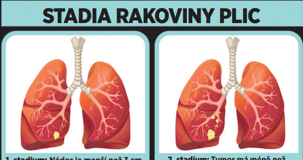 Stadia rakoviny plic