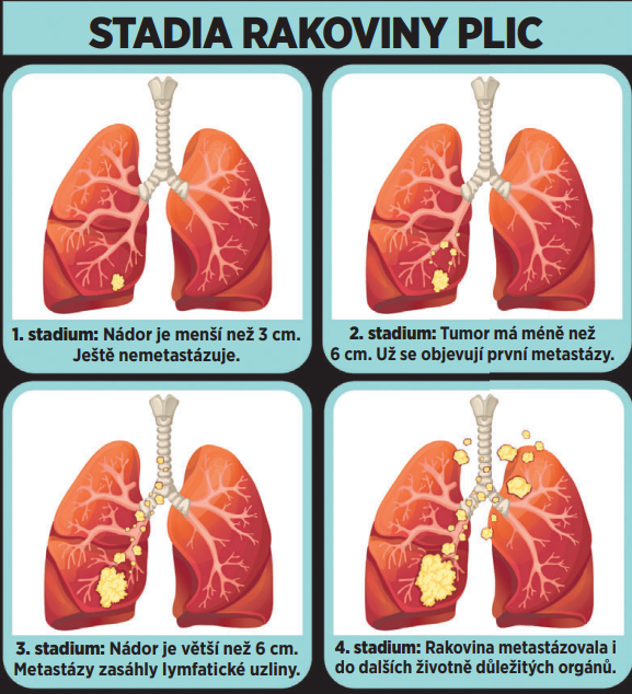 Graf Rakoviny GALERIE: Vědci přišli s překvapivým objevem: Co stojí za rakovinou plic ...