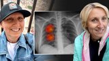 Lucie (52) má rakovinu plic, i když nekouřila: Šla k doktorovi s kašlem a přišlo děsivé odhalení