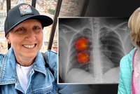 Lucie (52) má rakovinu plic, i když nekouřila: Šla k doktorovi s kašlem a přišlo děsivé odhalení