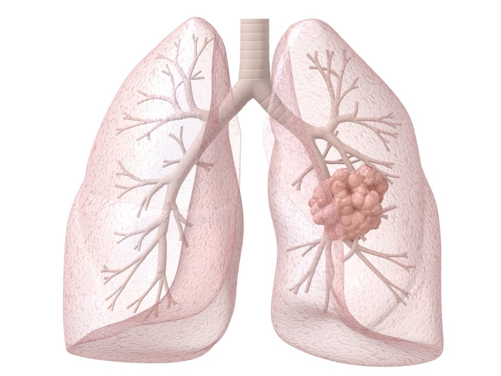 Pravá plíce napadená zhoubným nádorem.