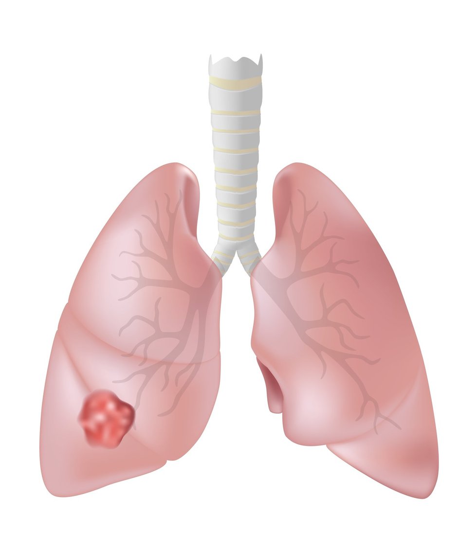 Plíce s karcinomem