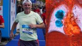 Romanův (60) boj s rakovinou plic: Nikdy nekouřil! Chorobu odhalila náhoda