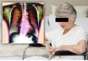 Lékaři u seniorky odhalili pokročilou rakovinu plic. Život jí zachránila  imunologická léčba.(ilustrační foto)