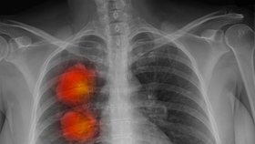 Riziko rakoviny plic zvyšuje znečištěné ovzduší, potvrdili vědci. A hlásí zásadní milník