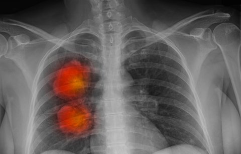 Riziko rakoviny plic zvyšuje znečištěné ovzduší, potvrdili vědci. A hlásí zásadní milník
