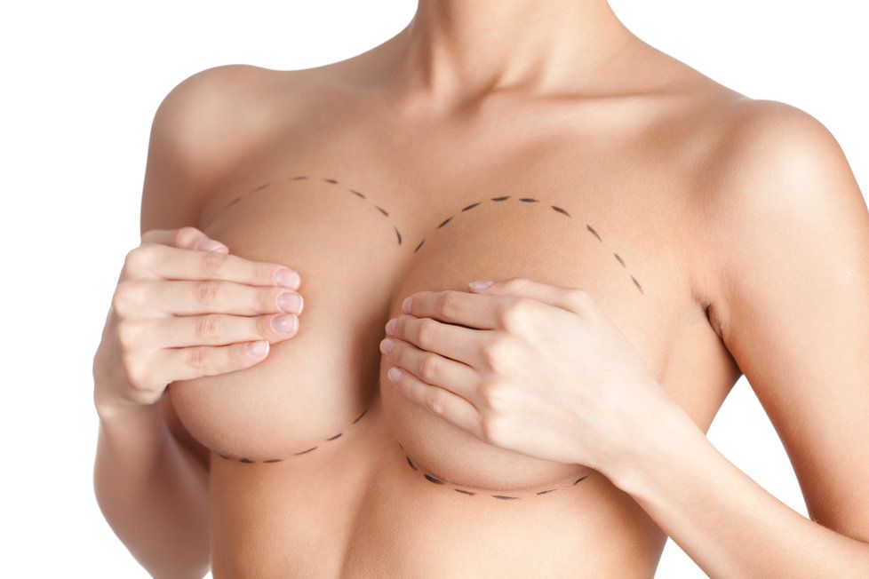 Francouzský kasační soud dnes nařídil nový proces v kauze vadných prsních implantátů francouzské firmy PIP, které dostaly desítky tisíc žen po celém světě, včetně Češek. (ilustrační foto)
