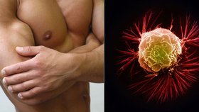 Rakovinu prsu mohou mít i muži.