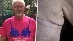 Mark měl rakovinu prsu a pomáhá s osvětou. Onkoložka: Muži změny v oblasti bradavek ignorují