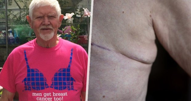 Mark měl rakovinu prsu a pomáhá s osvětou. Onkoložka: Muži změny v oblasti bradavek ignorují