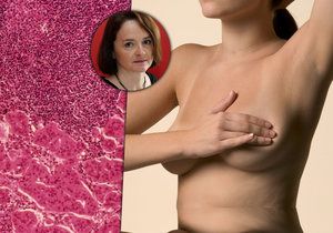 Jak může vzniknout rakovina prsu a jak probíhá léčba?