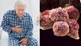 Zákeřná rakovina slinivky: Pacienti nešli kvůli pandemii k lékaři, nádor pak nešel operovat